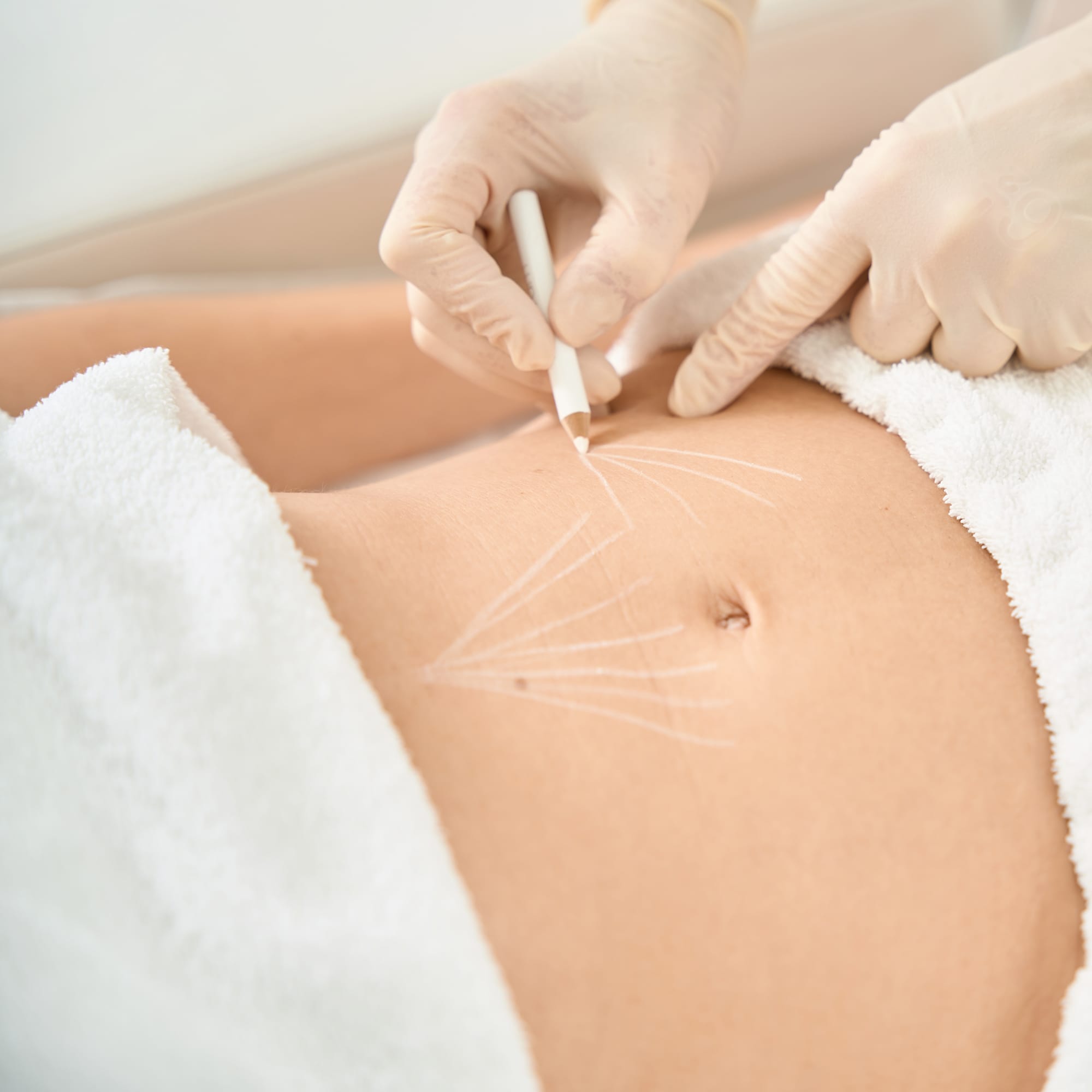 Procedimiento médico de lipoláser para tratar grasa localizada sin cirugía.