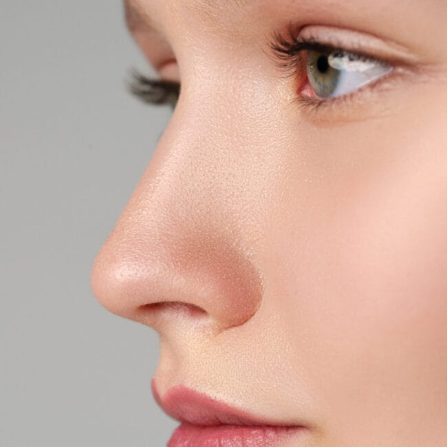 Rinomodelación con ácido hialurónico mejorar el perfil sin pasar por quirófano