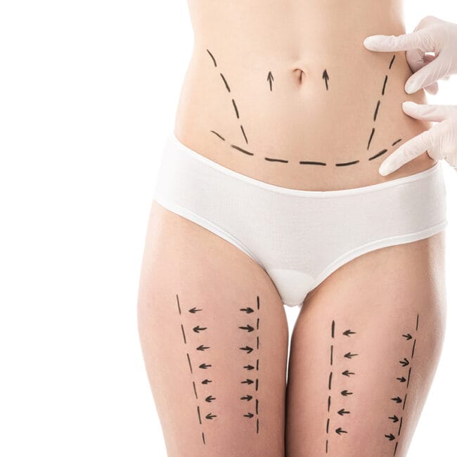 Endoláser corporal: por qué planificarlo antes del verano