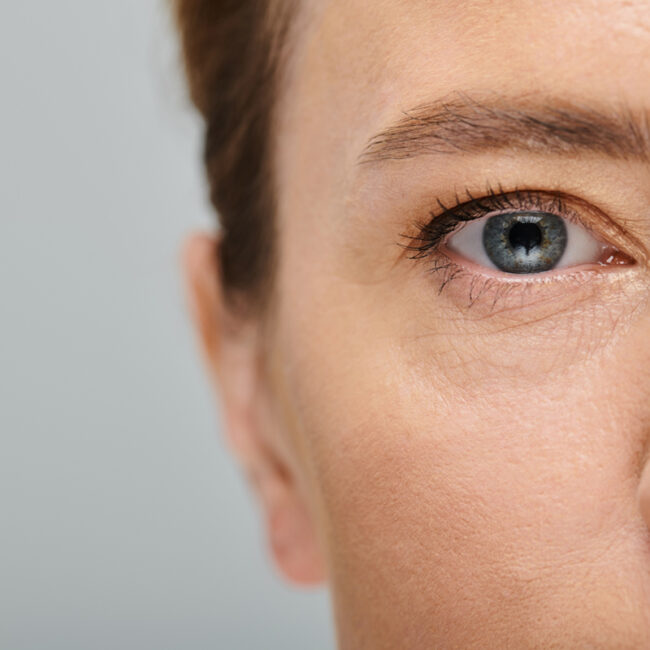 Paciente tras tratamiento para eliminar ojeras en Sevilla