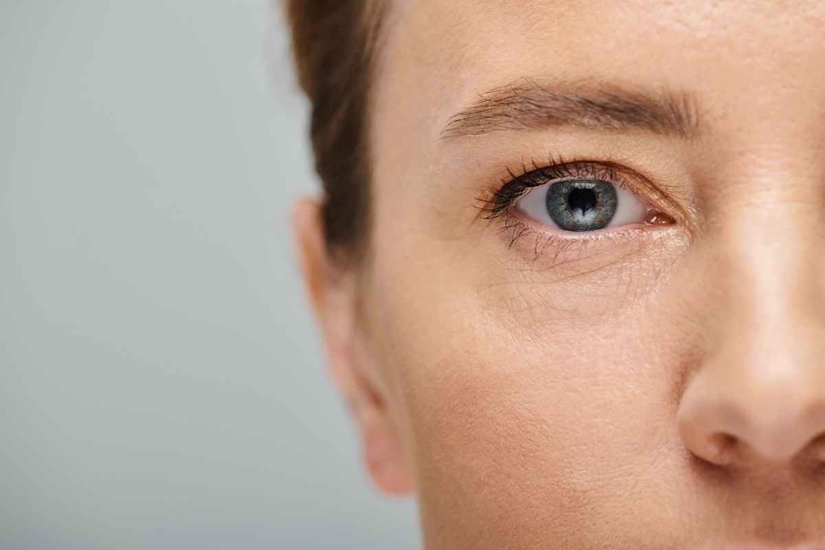 Paciente tras tratamiento para eliminar ojeras en Sevilla