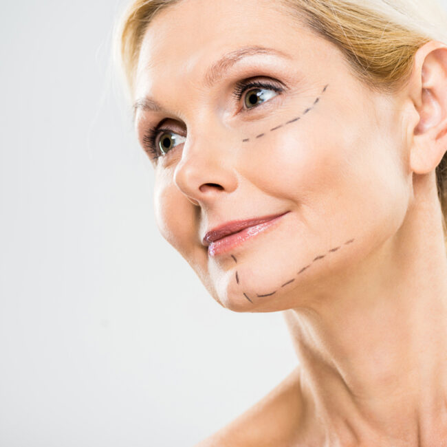 Paciente tras rejuvenecimiento facial en Sevilla