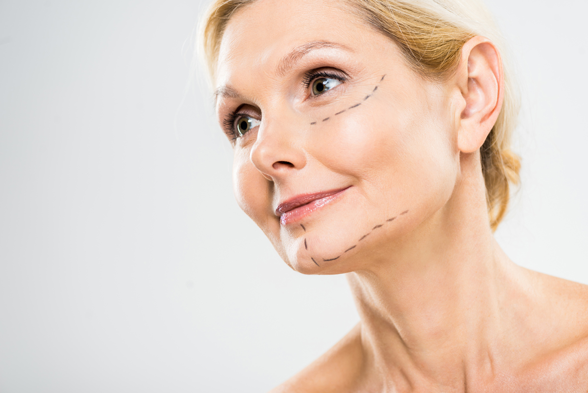 Paciente tras rejuvenecimiento facial en Sevilla