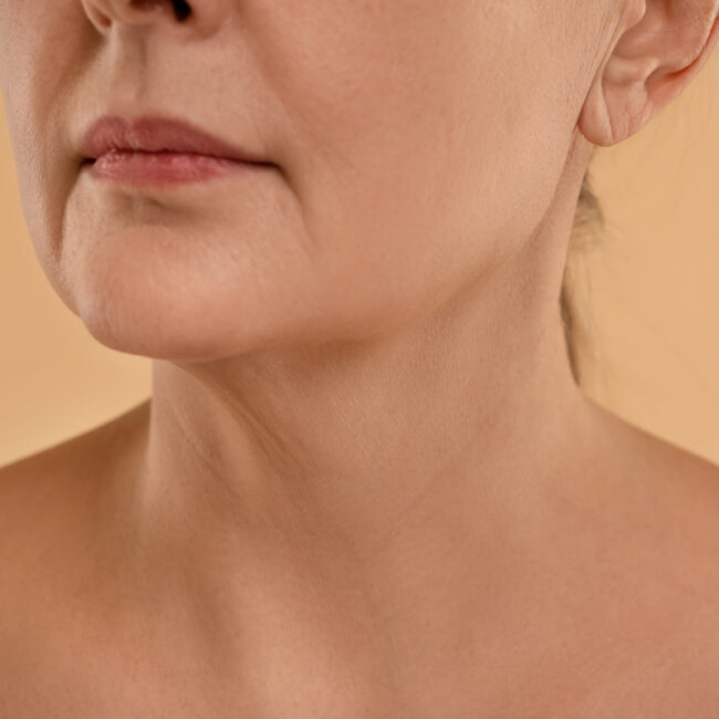 Paciente tras tratamiento de flacidez facial con endoláser en Sevilla