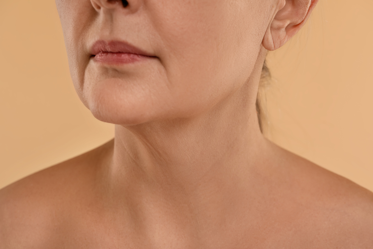 Paciente tras tratamiento de flacidez facial con endoláser en Sevilla